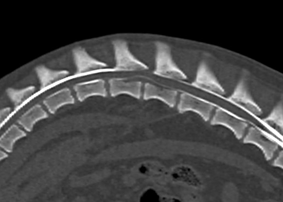 椎間板ヘルニア